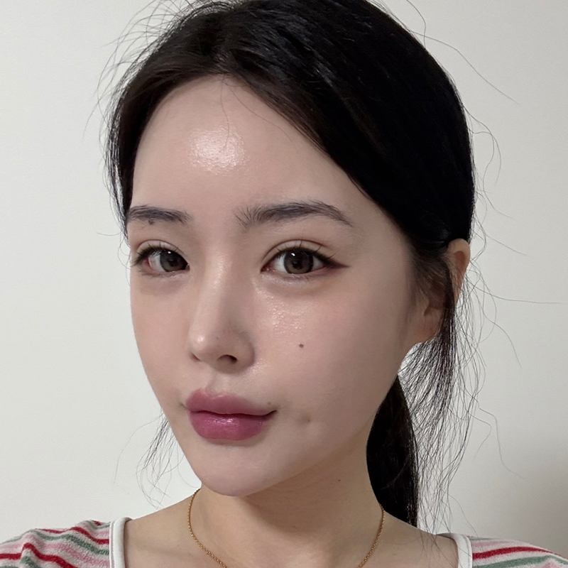 팝성형외과에서 12홀자연유착+뒤밑트임 1개월차 후기입니다!:)