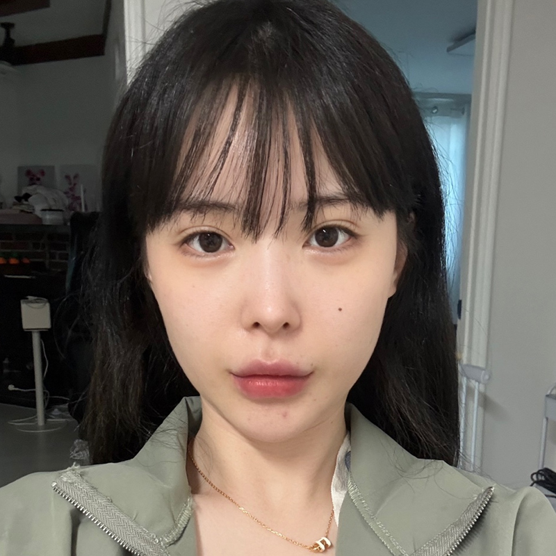 팝성형외과에서 12홀자연유착+뒤밑트임 2개월차 후기입니다!