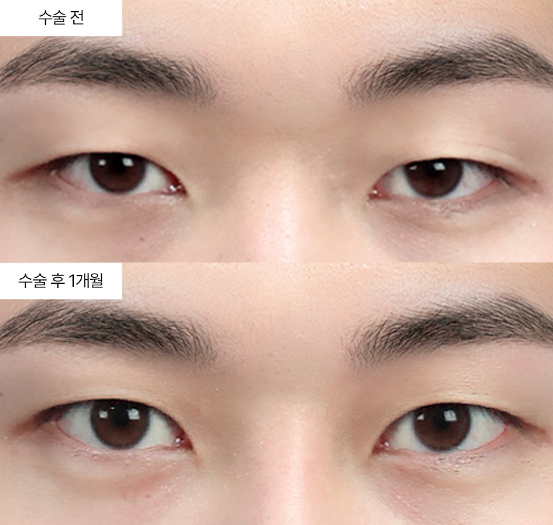 12홀자연유착