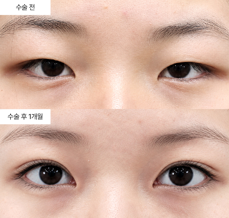 12홀 자연유착+눈매교정+윗트임+앞트임