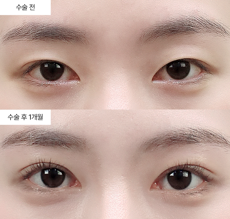 12홀 자연유착