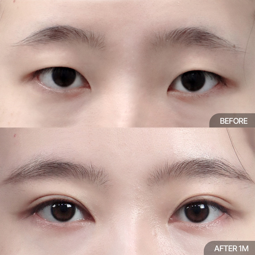12홀 자연유착+위트임+앞트임