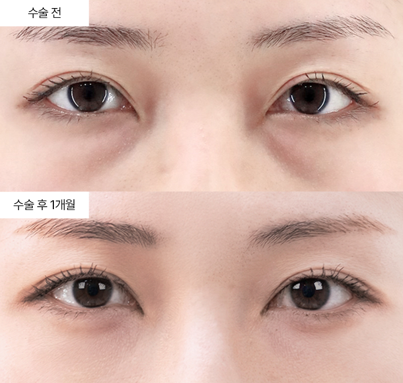 눈밑지방재배치