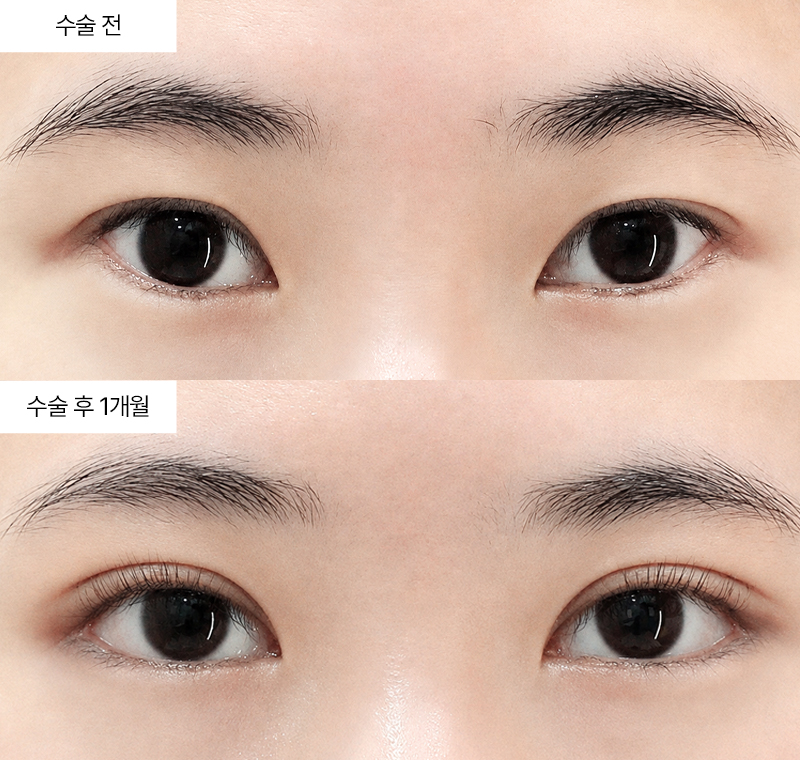 12홀 자연유착+뒤트임+눈꼬리내리기