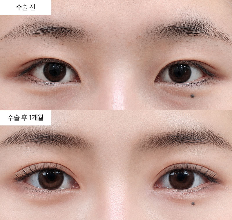 12홀 자연유착+앞트임+윗트임