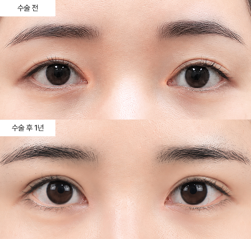 12홀 자연유착+앞트임복원