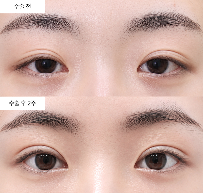 12홀 자연유착+눈매교정