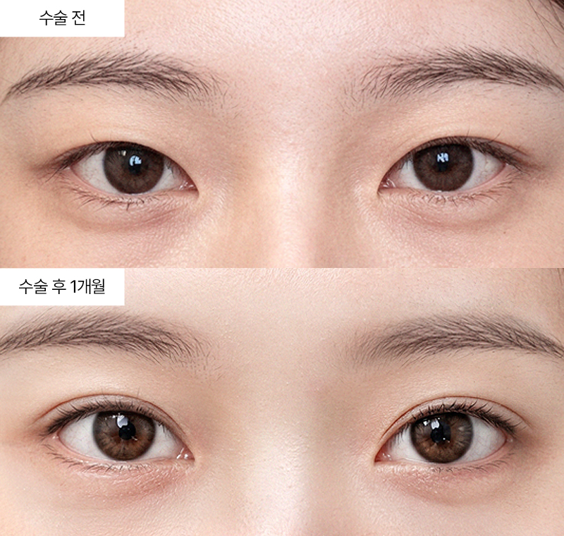 12홀 자연유착+윗트임+앞트임