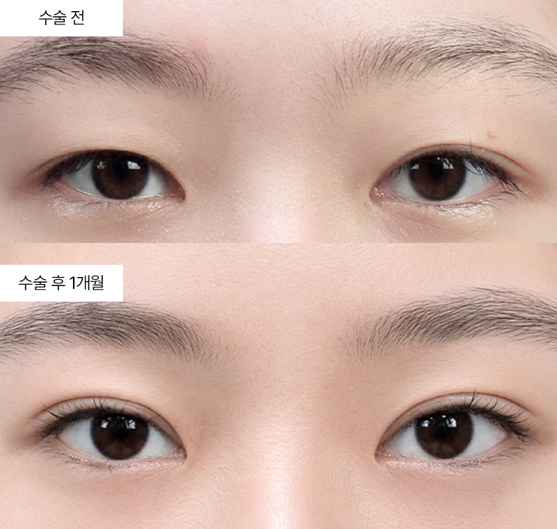 12홀 자연유착+앞트임