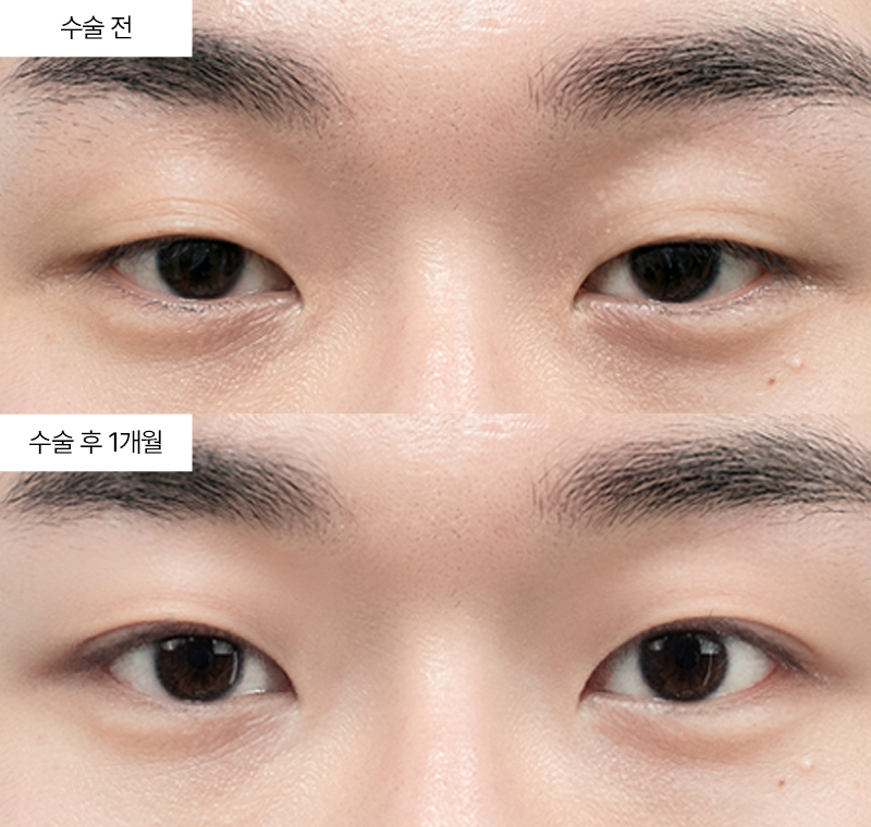 12홀 자연유착+눈매교정+밑트임