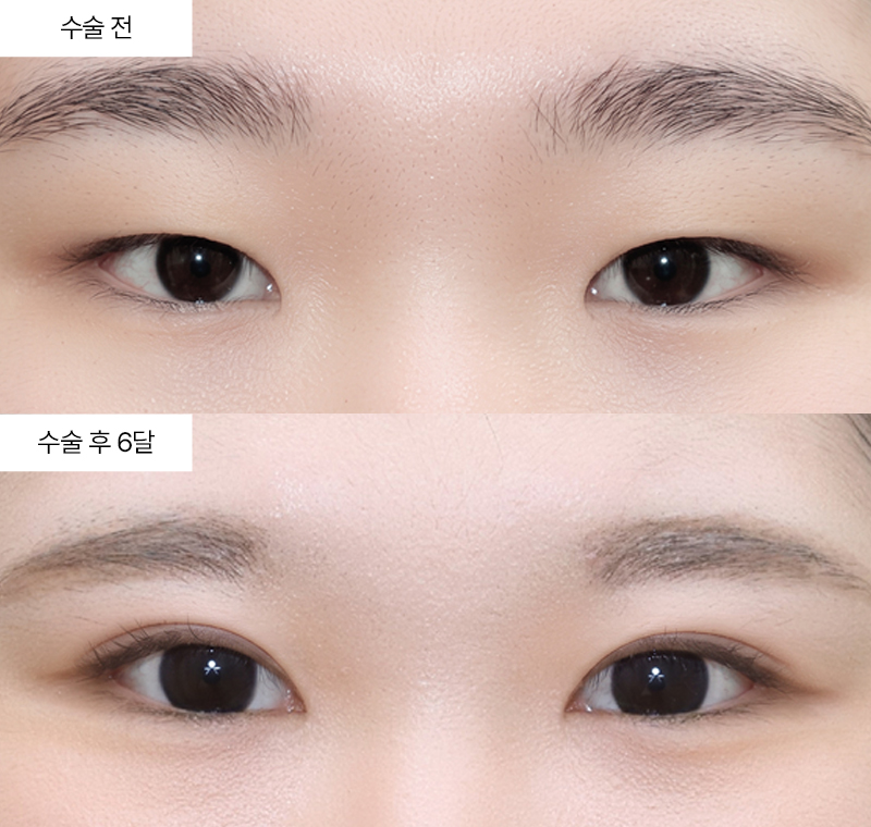 세줄유착+눈매교정+앞트임+윗트임