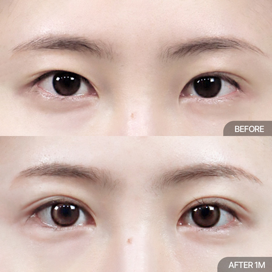 12홀 자연유착+윗트임+밑트임