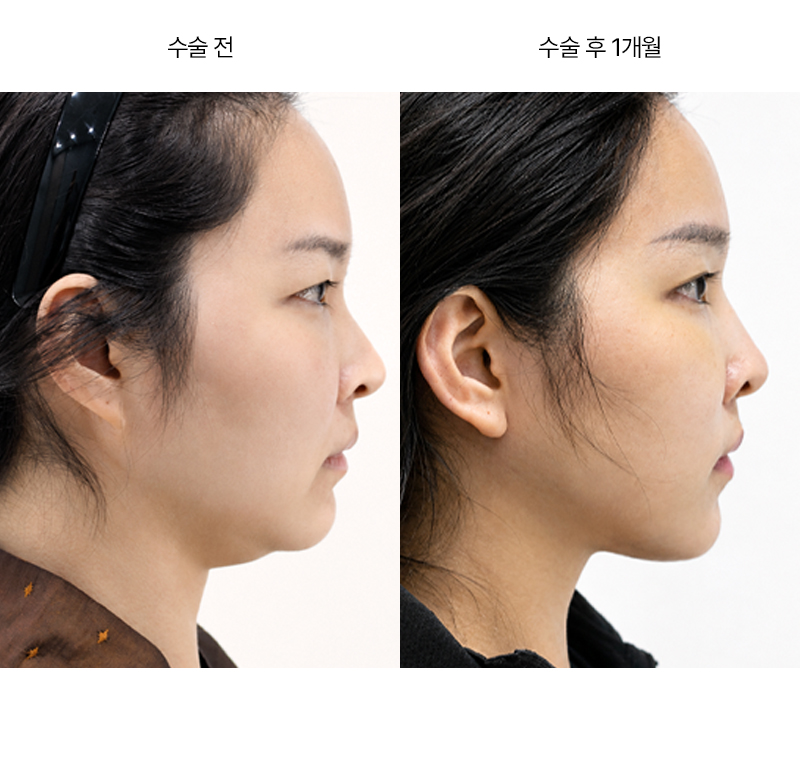 안면거상+목거상+이중턱 근육묶기