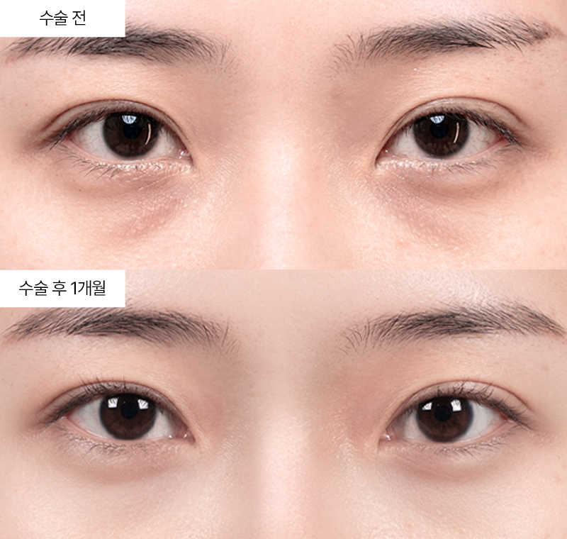 눈밑지방재배치
