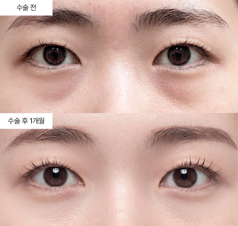 눈밑지방재배치