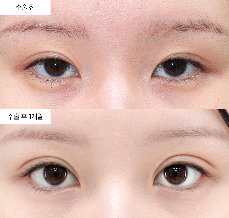 12홀 자연유착+눈매교정+윗트임+뒤트임+밑트임