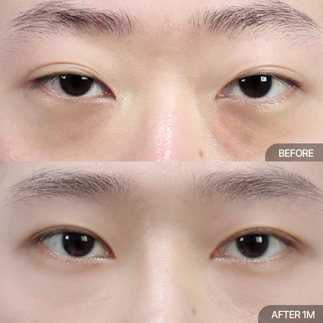 눈밑지방재배치+12홀자연유착+눈매교정