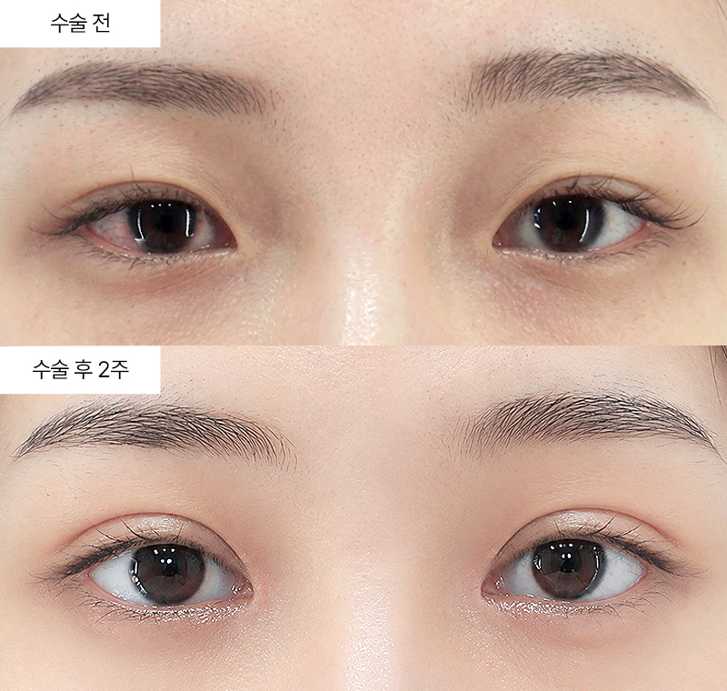 12홀 자연유착+눈매교정+윗트임+앞트임