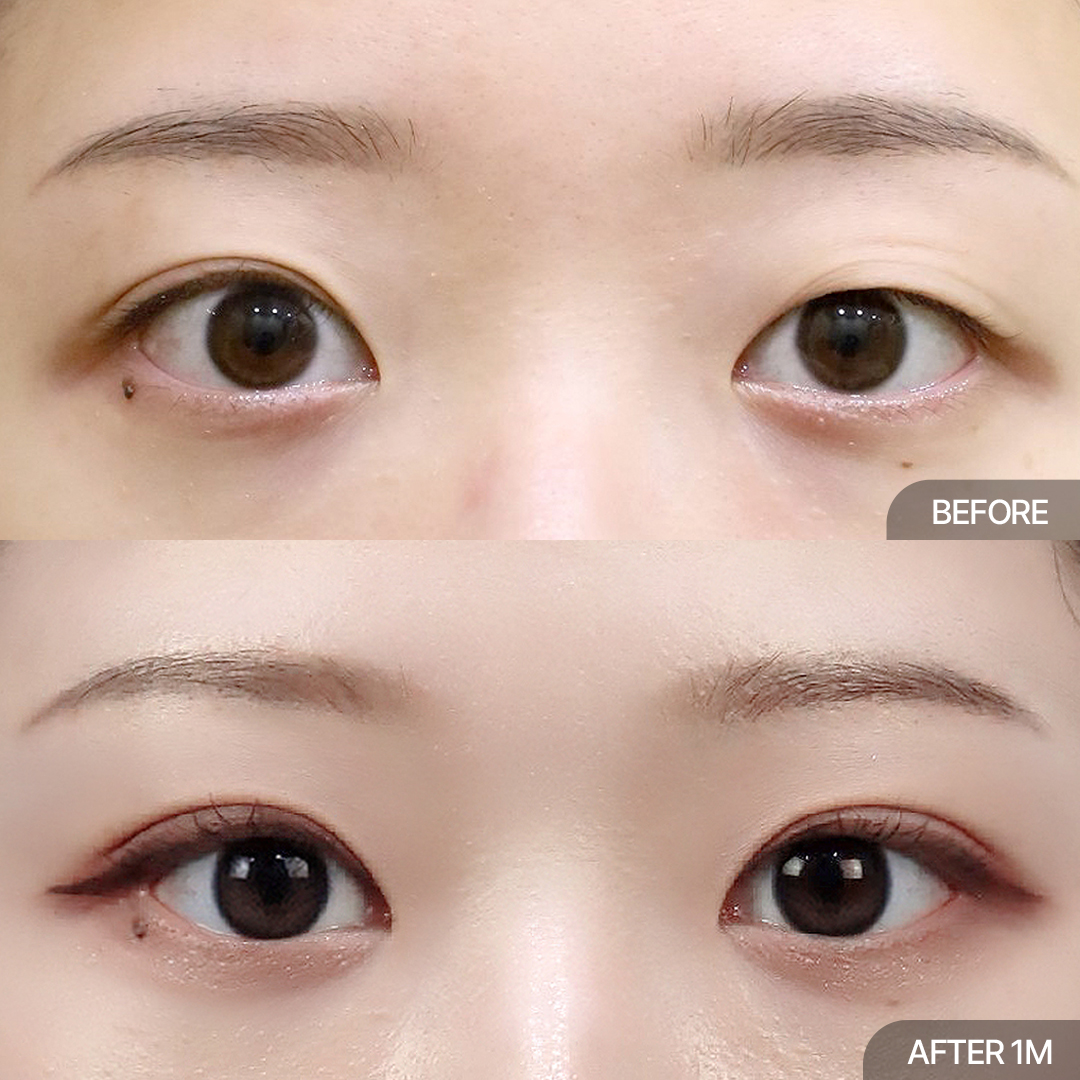 12홀 자연유착+눈매교정