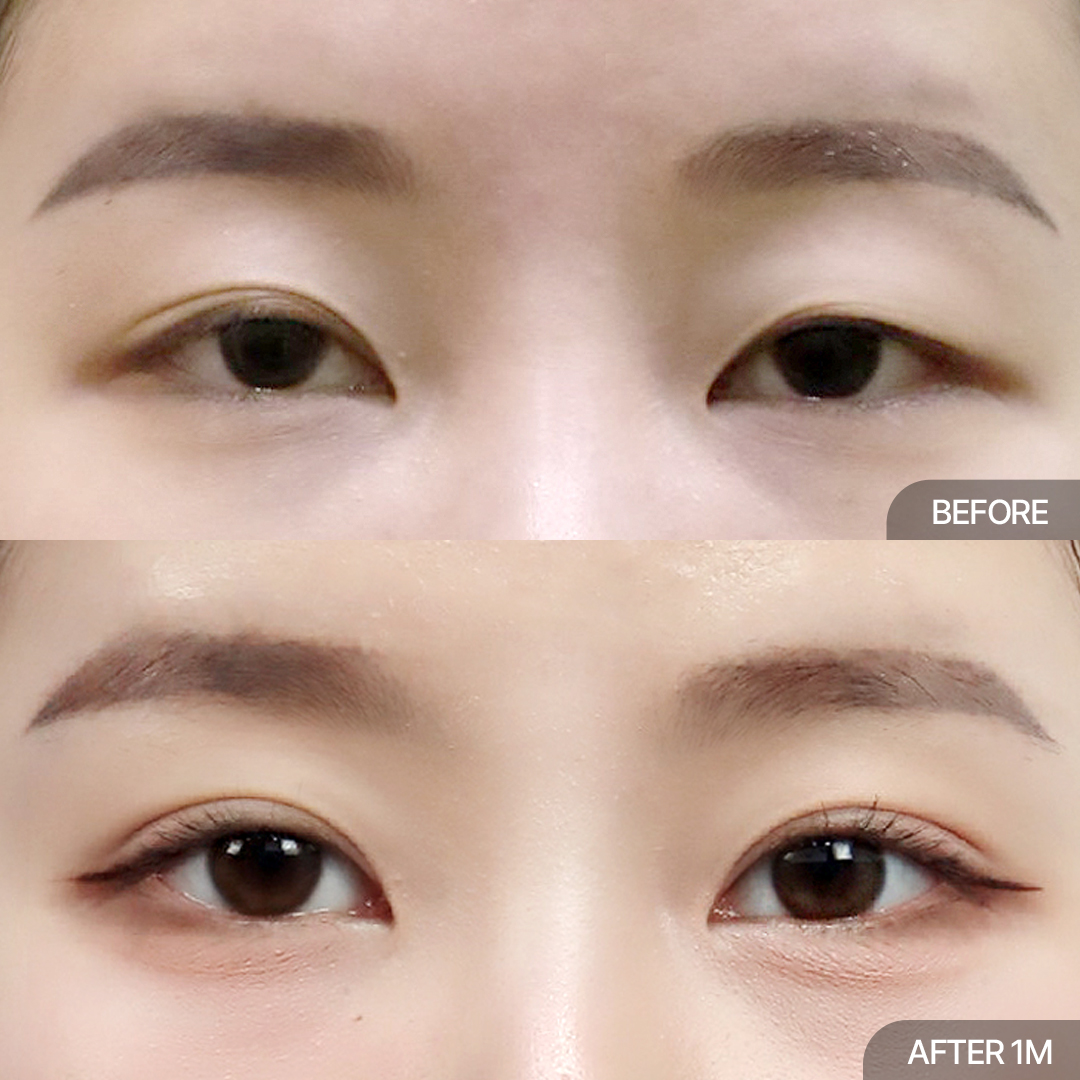 12홀 자연유착+눈매교정+윗트임
