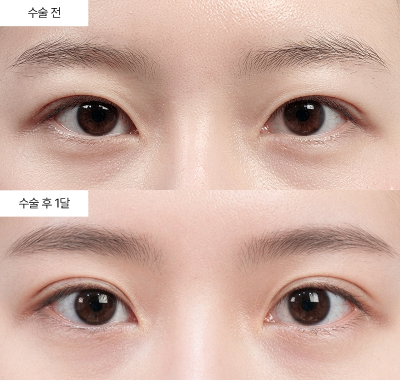 12홀 자연유착+윗트임