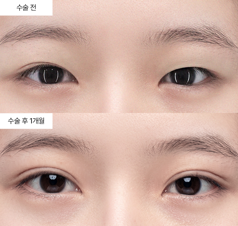 12홀 자연유착+눈매교정+윗트임