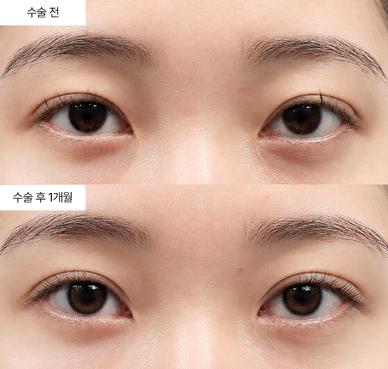 12홀 자연유착+윗트임