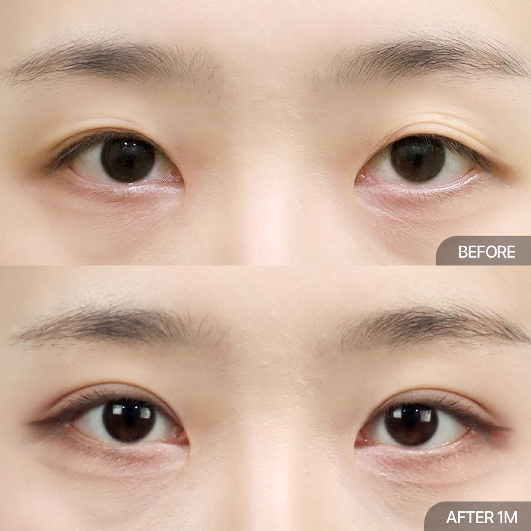 12홀 자연유착+앞트임