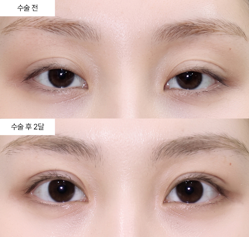 자연유착+윗트임+앞트임+눈매교정