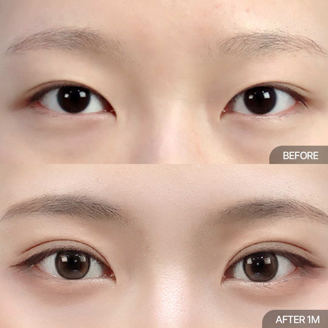 12홀 자연유착+윗트임