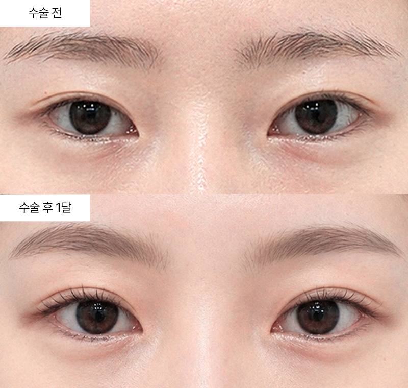 12홀 자연유착+뒤트임+밑트임
