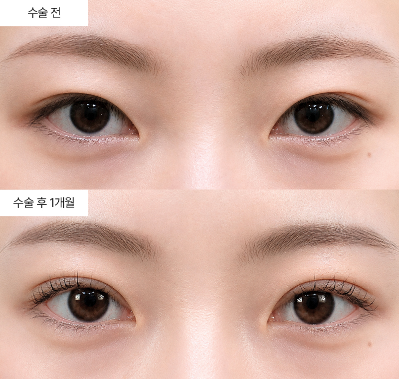 12홀 자연유착+윗트임