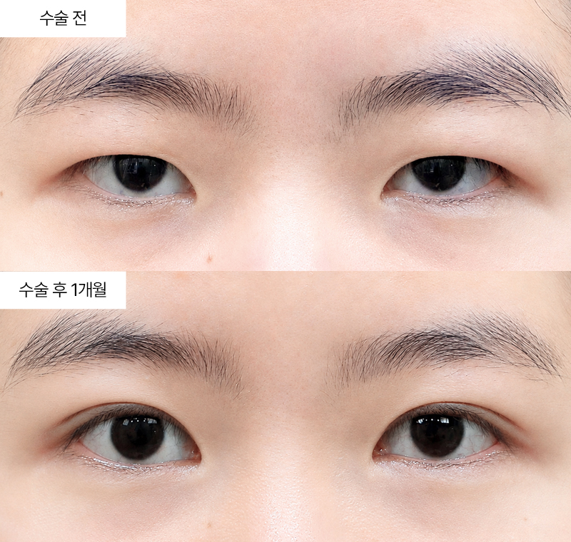 12홀 자연유착+윗트임+앞트임+눈매교정+눈위지방제거