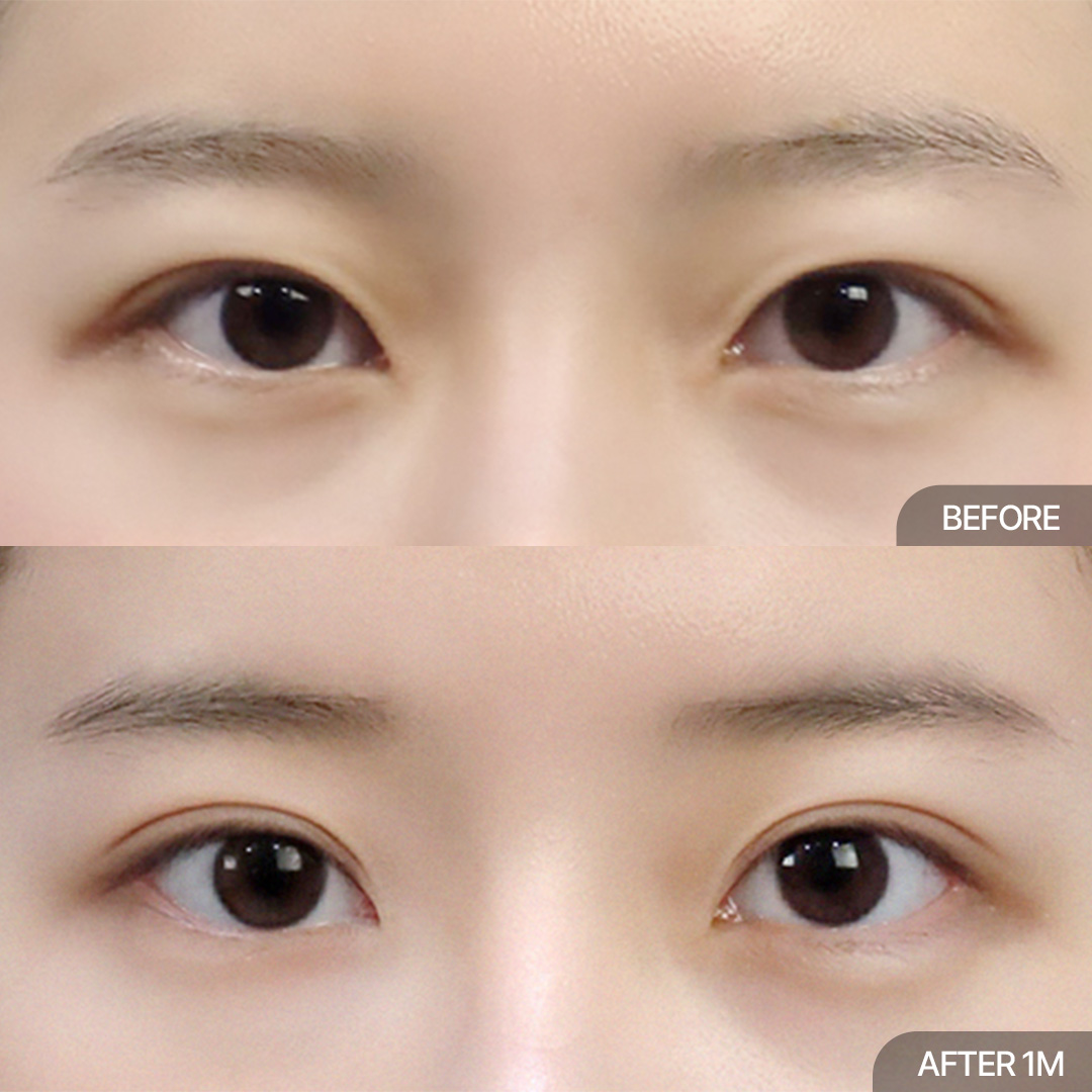12홀 자연유착+윗트임+앞트임