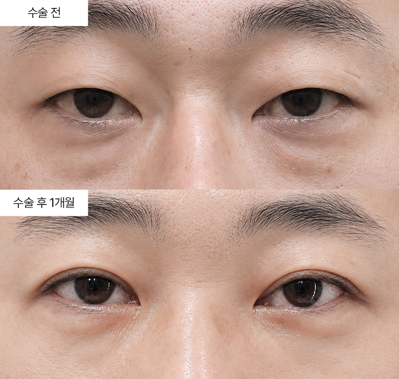 절개쌍꺼풀+눈밑지방재배치