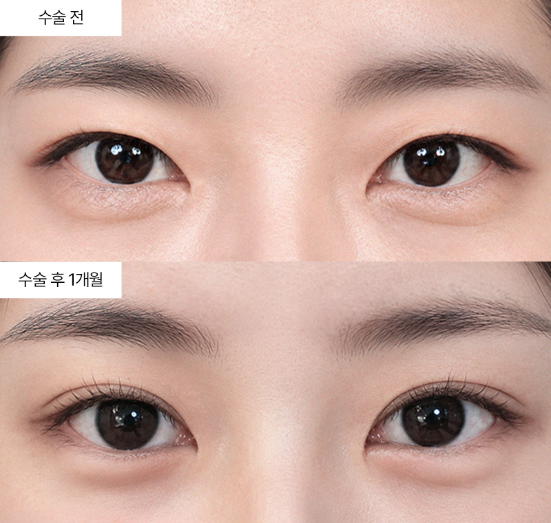 12홀 자연유착+윗트임
