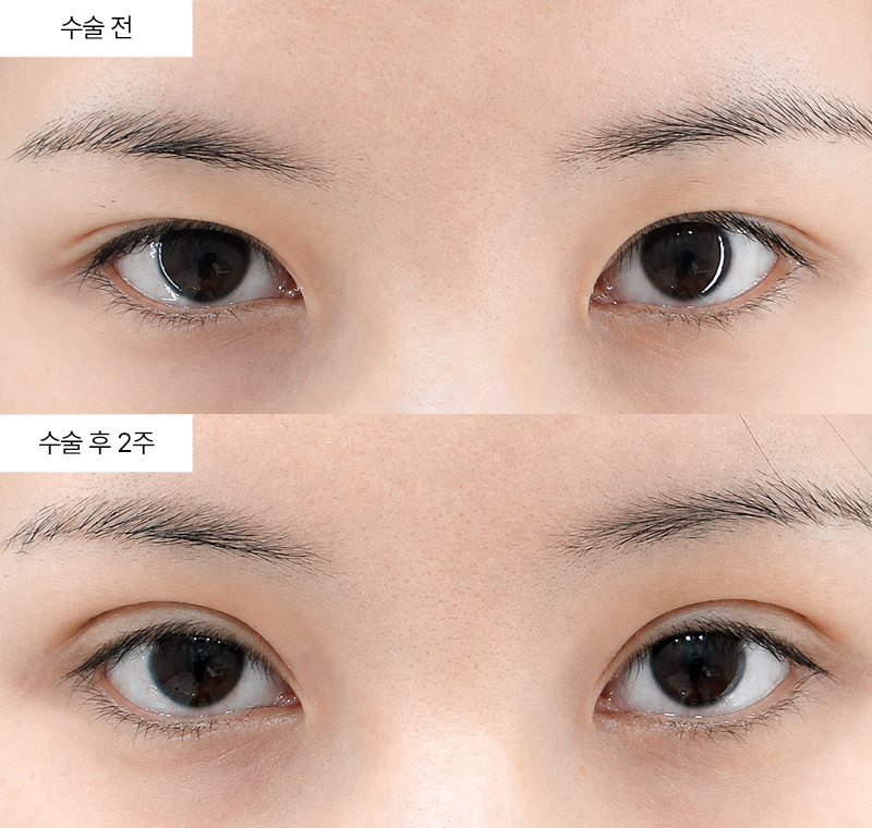 이마거상+12홀 자연유착+윗트임