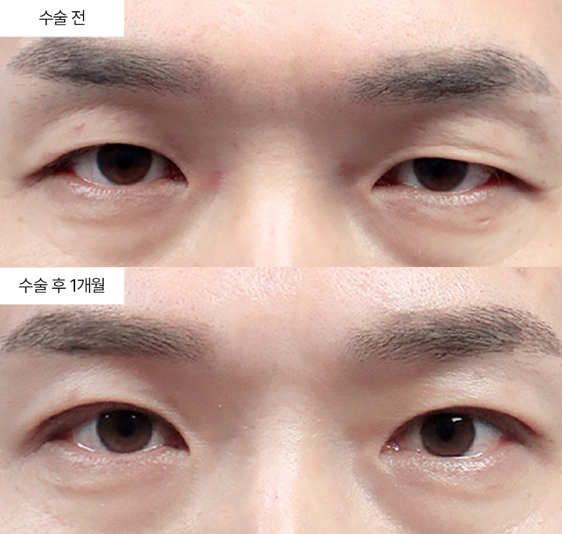 12홀자연유착+눈매교정