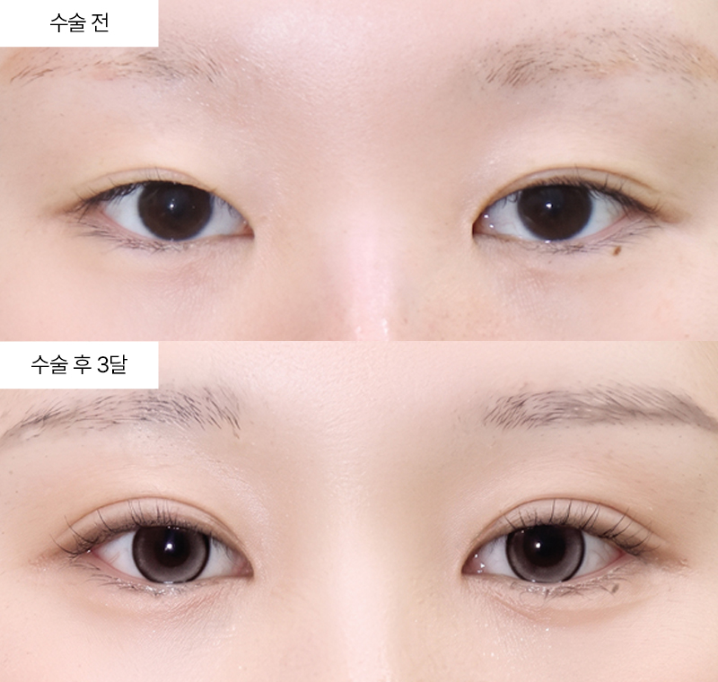 눈재수술+윗트임+앞트임+뒤트임+밑트임