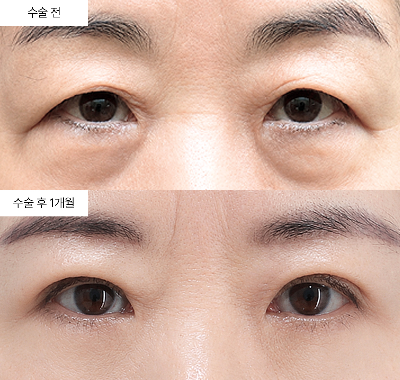 눈썹하거상+12홀 자연유착+하안검