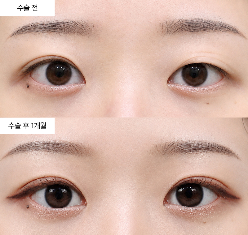 12홀 자연유착+눈매교정