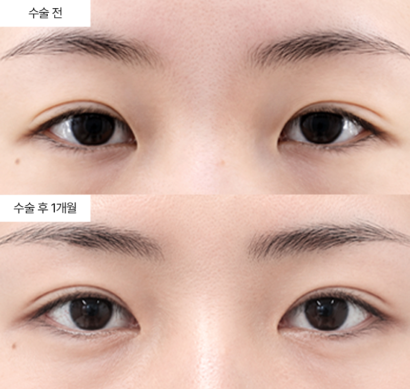 윗트임+앞트임