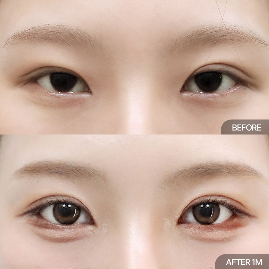 12홀 자연유착+위트임+앞트임
