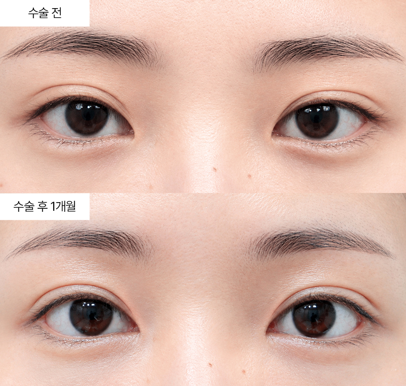 12홀 자연유착+윗트임+앞트임
