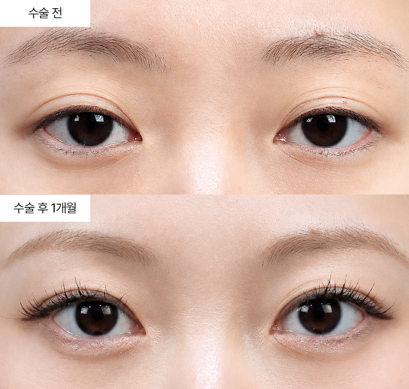 절개+눈위지방재배치