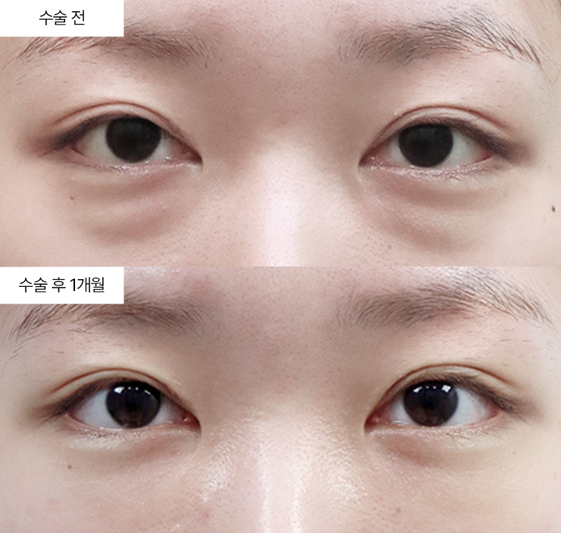 눈밑지방재배치