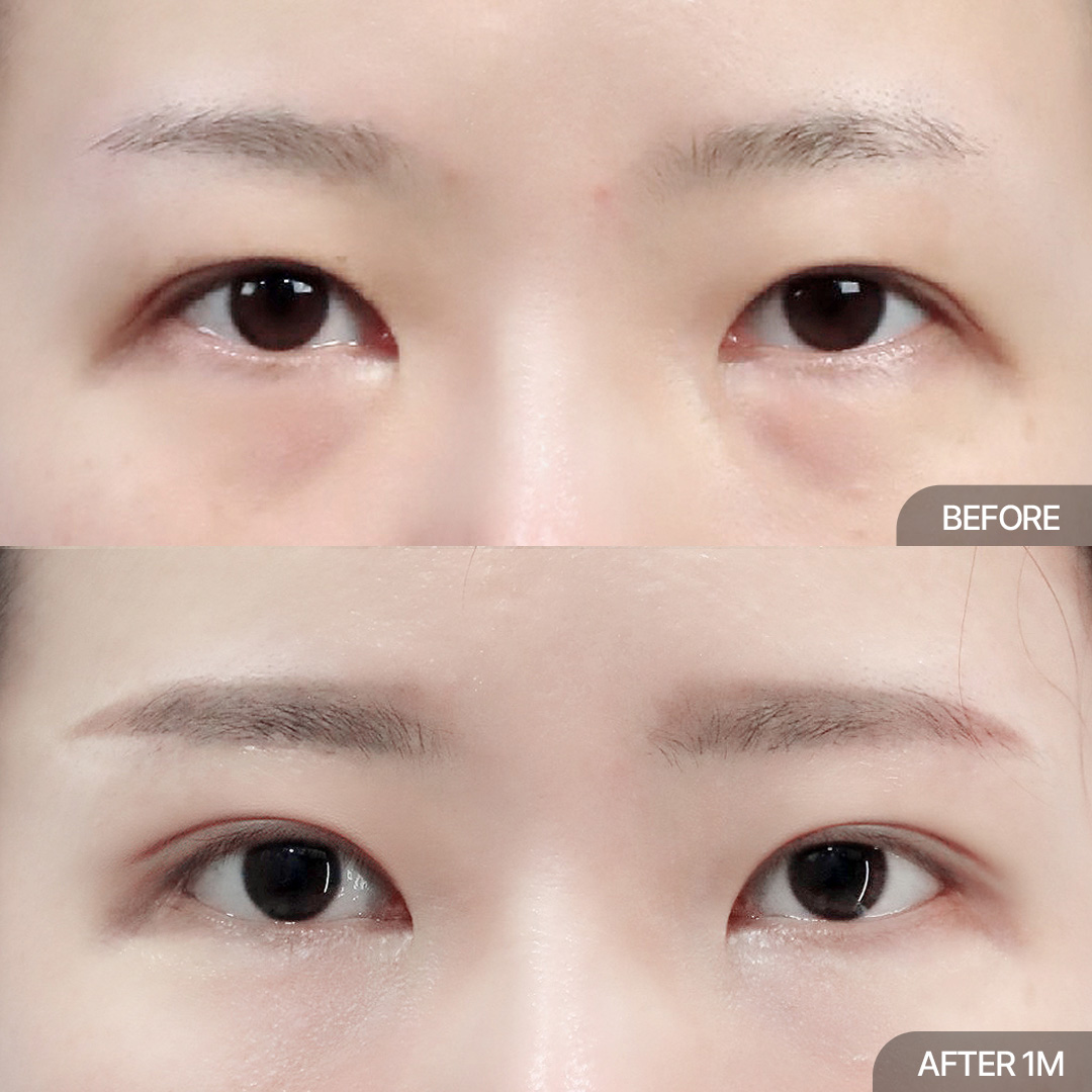 눈썹하거상+12홀자연유착+눈매교정+눈밑지방재배치