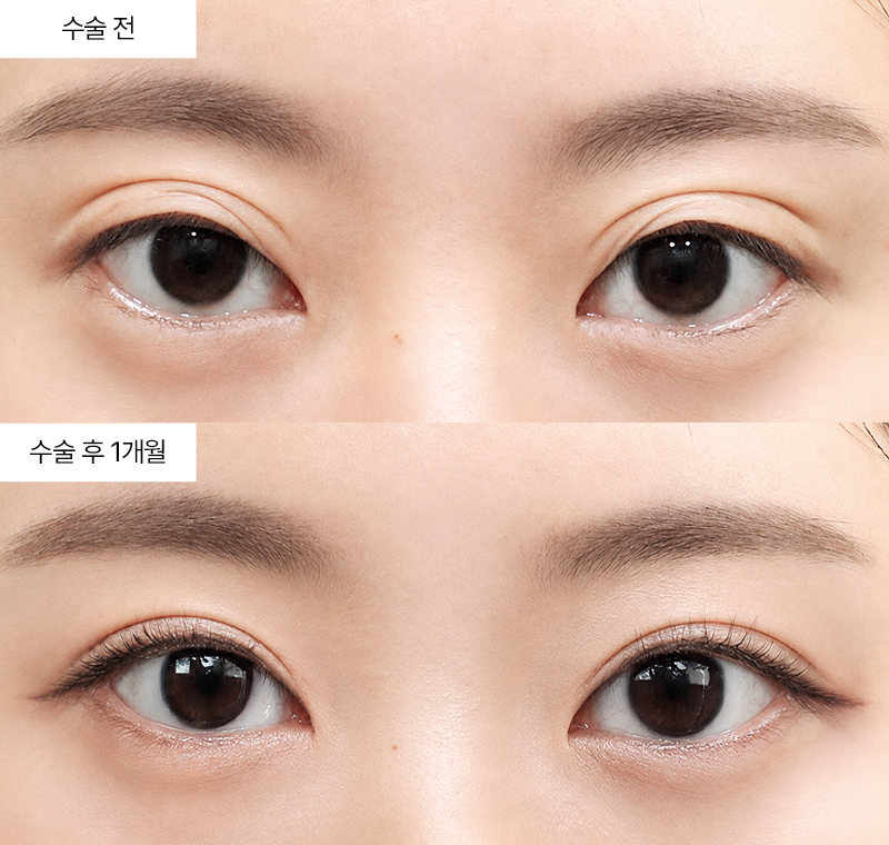 두줄따기+눈위지방재배치+눈매교정