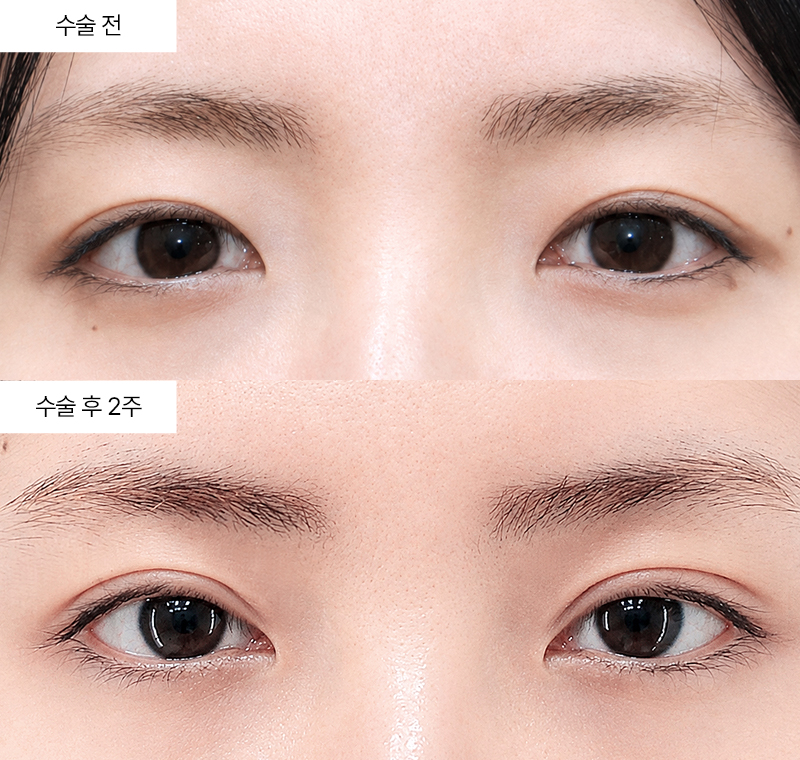 12홀 자연유착+눈매교정+윗트임