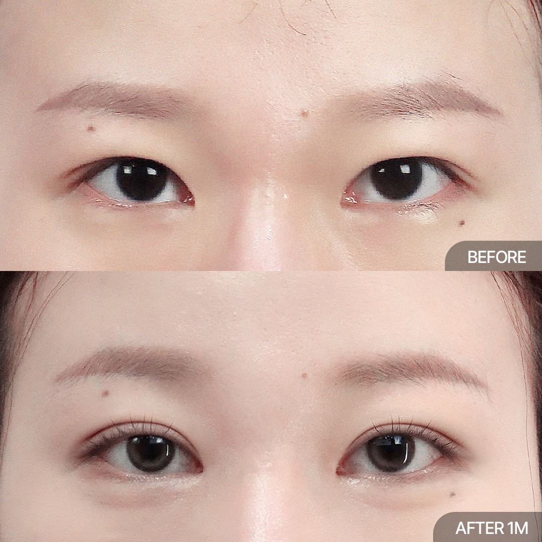 이마거상+12홀자연유착+위트임+앞트임